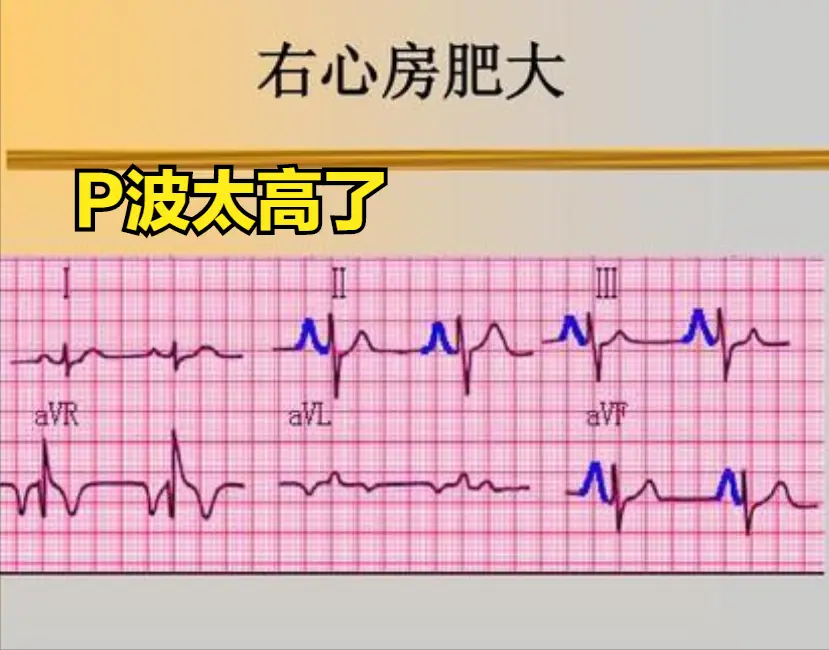 心电图厂波改变_心电图电波改变_心电图q波改变原因