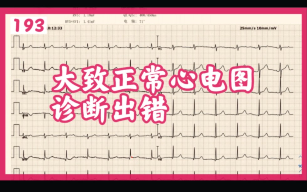 心电图电波改变_心电图q波改变原因_心电图厂波改变