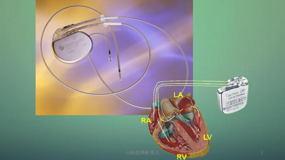 心脏手术起搏器多久能恢复_心脏手术起搏器_心脏起搏器手术过程